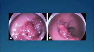 Post-operative Complications: Endoscopic Management