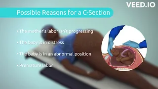 Touch Surgery Simulation - Cesarean Section (Pregnant  Women Delivery Information video)