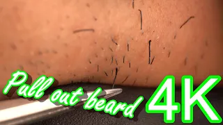 How Ingrown Hairs Are Removed 4K HQ 20210508