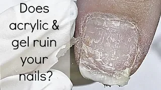 IS ACRYLIC OR GEL BAD FOR YOUR NAILS?