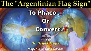 The Argentinian Flag SIgn - Now What..?- To Phaco or to Convert..? Dr Deepak Megur