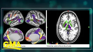 A look at our correspondent’s brain on sugar