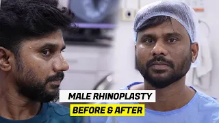 MALE Rhinoplasty Nose Job in India | Day 10 After Surgery | Before & After