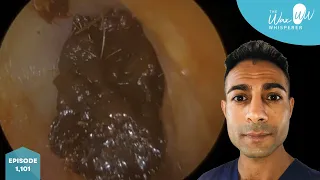 1,101 - Fully Blocked Ear Wax Removal from Both Ears