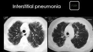 Imaging of Diffuse lung diseases   Prof Dr  Mamdouh Mahfouz In Arabic