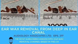 EAR WAX REMOVAL FROM DEEP IN EAR CANAL - EP 217