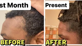 **INSANE** Microneedling Before/After Results For Hair Regrowth!! (MUST WATCH)