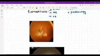 Ocular toxoplasmosis_Plab2