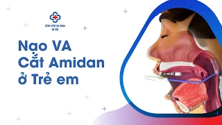 NẠO VA/ CẮT AMIDAN Ở TRẺ EM | Bệnh viện Đa khoa Hà Nội