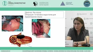 Современные стандарты лечения плоскоклеточного рака головы и шеи (Раджабова З.А.)