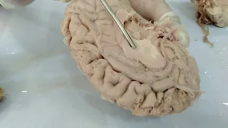 Basal Ganglia of Brain / Neuroanatomy