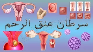 احذرن هذه العلامات لسرطان عنق الرحم