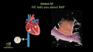 Focused cardiac ultrasound (FoCUS) for the Nephrologist: core pathologies | Dr. Koratala @NephroP