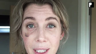 Blepharoplasty Video Diary - 3 Weeks After Surgery (13 of 15)