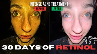 I tried TRETINOIN for 30 days... | acne treatment full documentation