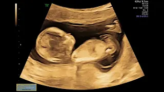 Baby 4D Ultrasound 2022