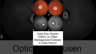 Optic Disc Drusen ODD an Often Misdiagnosed Disease