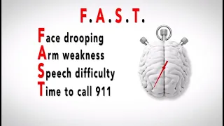 How to Identify a Stroke - Think F.A.S.T.