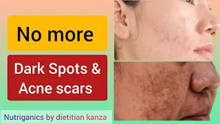 Top 2 Nutrients to get rid of Dark spots, Acne scars, Pigmentation Fast | Dietitian kanza