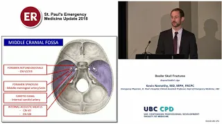 Basilar Skull Fractures (St Paul's EM Update 2018)