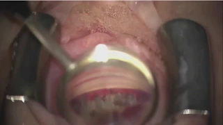 Managing Endothelial Cell Loss after MIGS Procedures (Malik Y. Kahook, MD)