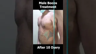 Male Boobs Treatment Before After Results | Gynecomastia Before After Results