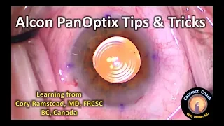 Alcon PanOptix Trifocal IOL Tips & Tricks for Cataract Surgery