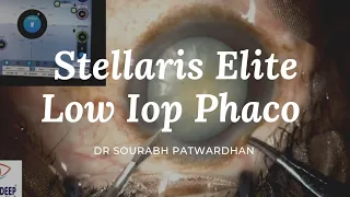 Stellaris Elite Sourabh Patwardhan Live Phaco surgery. For training and consultation call 9220001000