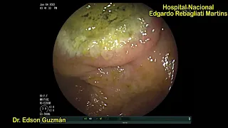ILEOCECAL VALVE ULCER AS PRESENTATION OF DIFFUSE LARGE B- CELL LYMPHOMA