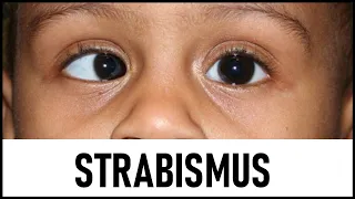 Strabismus Lecture - Part I