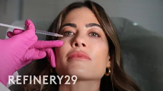 I Dissolved My Under Eye Filler | Macro Beauty | Refinery29