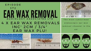 4 X EAR WAX REMOVAL INC 2CM : 3:4" EAR WAX PLUG REMOVAL   EP372