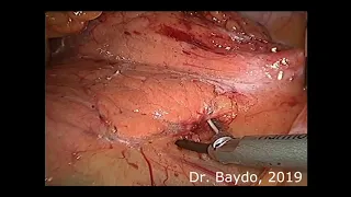 Laparoscopic spleen sparing distal pancreatectomy
