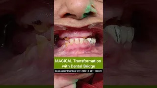 MAGICAL Teeth Transformation with lower arch dental bridge; Dr. Srishti Bhatia #teeth #dental