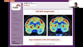 ILAE East Mediterranean EpiCases 2023 - Temporal Lobe Epilepsy: Challenges from Semiology to Surgery