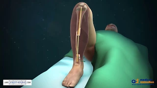 Tibial Bone Transport Over an Intramedullary Nail Using Cable and Pulleys