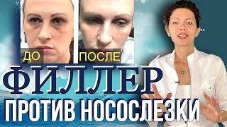 ФИЛЛЕРЫ и НОСОСЛЕЗНАЯ БОРОЗДА  👃💧💦  Заполнение Носослезной Борозды ФИЛЛЕРОМ  🔴 Наглядный Пример 🔴