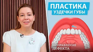 Пластика уздечки верхней губы (френулопластика)