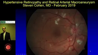 Hypertensive Retinopathy and Retinal Arterial Macroaneurysm