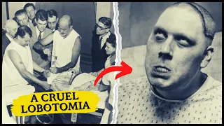 CONHEÇA A LOBOTOMIA UMA HORRIPILATE CIRURGIA CEREBRAL | Historicamente