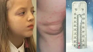 Tämä tyttö on allerginen kylmälle…