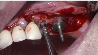 Sinus lifting using Osteotome