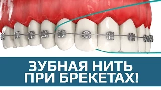 Флосс. Как правильно пользоваться зубной нитью при брекетах
