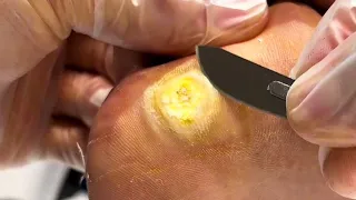 Pedicure Tutorial: A Quick Fix for Plantar Warts!