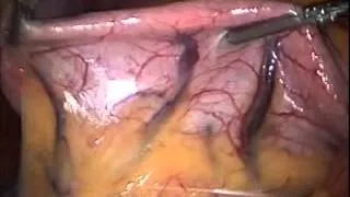 Laparoscopic Gastric Bypass Surgery by Dr. Sosa