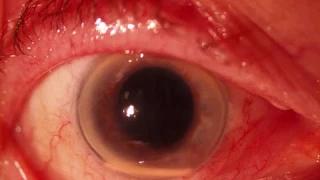 Endophthalmitis after Ozurdex injection. Or not?