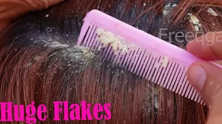 Amazing Big Flake In My Mother Hair !! | Many Dandruff Scratching Scalp #47