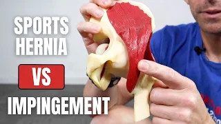 Hip Impingement vs Sports Hernia - What's the Difference?