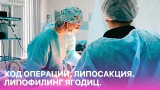 Липосакция. Липофилинг ягодиц. Ход операции в ОН КЛИНИК.