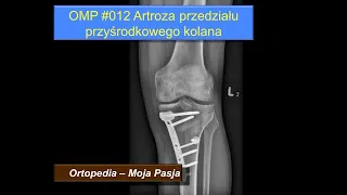 Artroza kolana. Zmiany zwyrodnieniowe przedziału przyśrodkowego stawu kolanowego | OMP #012